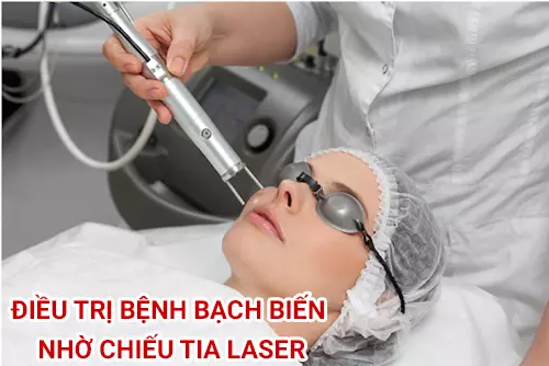Chieu-tia-laser-la-phuong-phap-dieu-tri-bach-bien-kha-thong-dung.webp